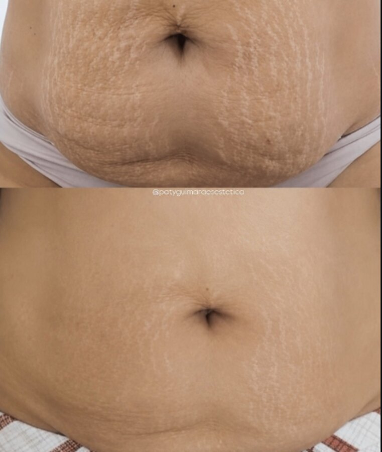 Antes e depois de estrias no abdômen