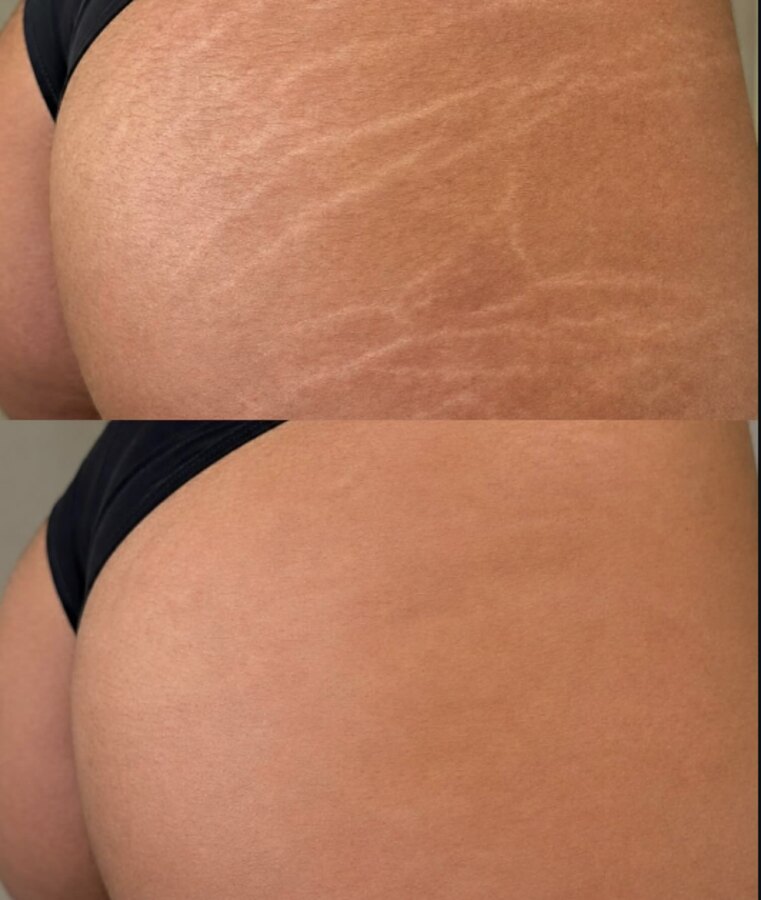Antes e depois de estrias no glúteo