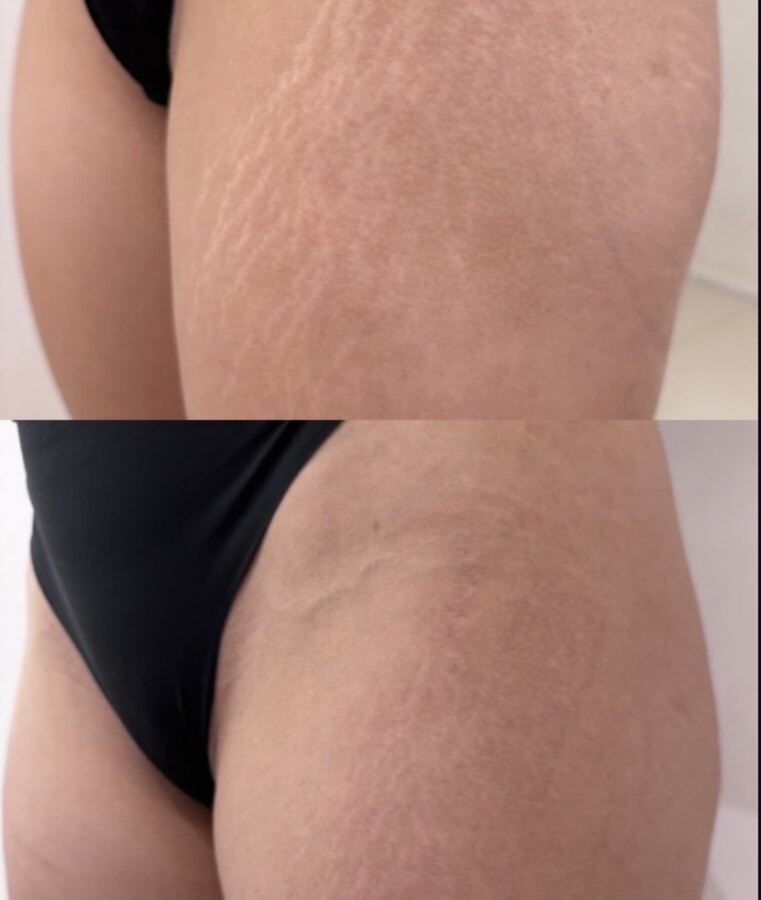 Antes e depois de estrias na coxa