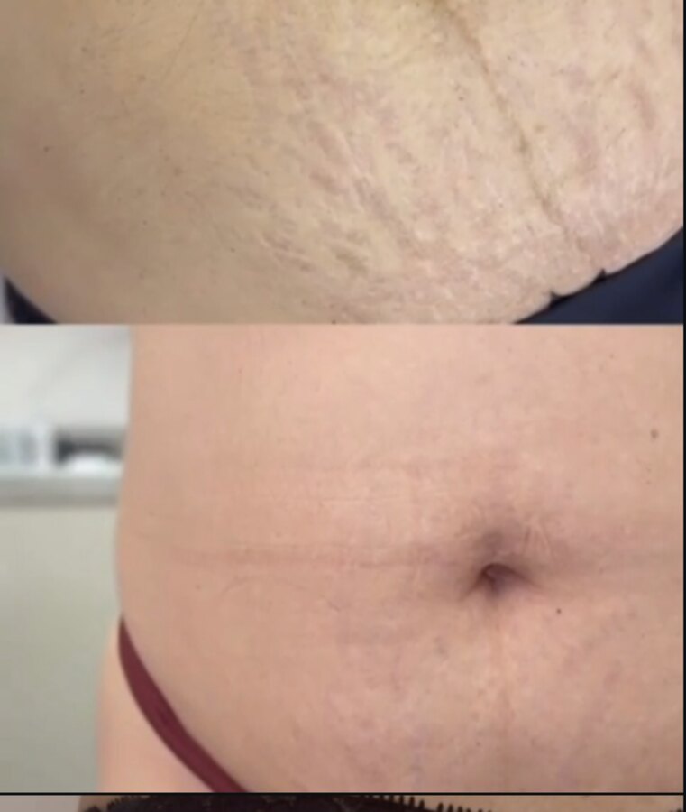 Antes e depois na região abdominal