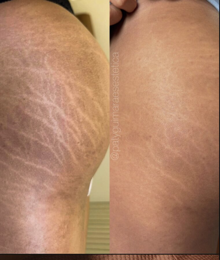 Antes e depois de estrias brancas