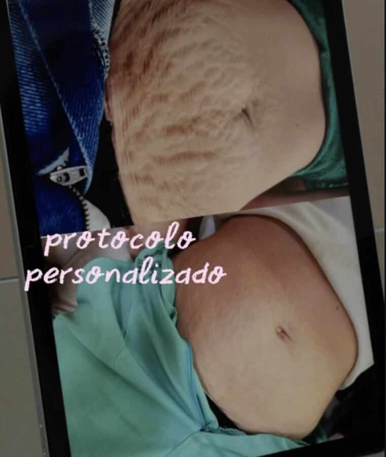Resultado de manchas e melasma